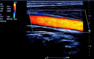 Carotis-Vertebralis Duplexsonographie